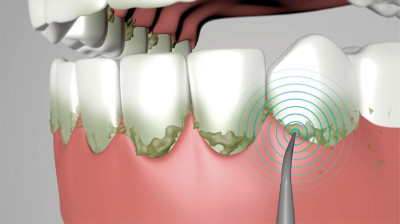 Starlyf Nettoyeur dentaire à ultrasons - Embouts de rechange