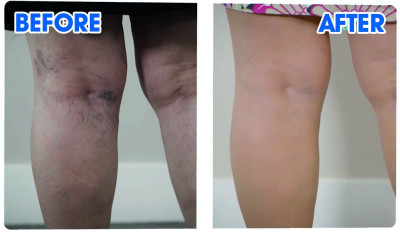 Veins Gone - spray and activator cream for beautifully smooth legs